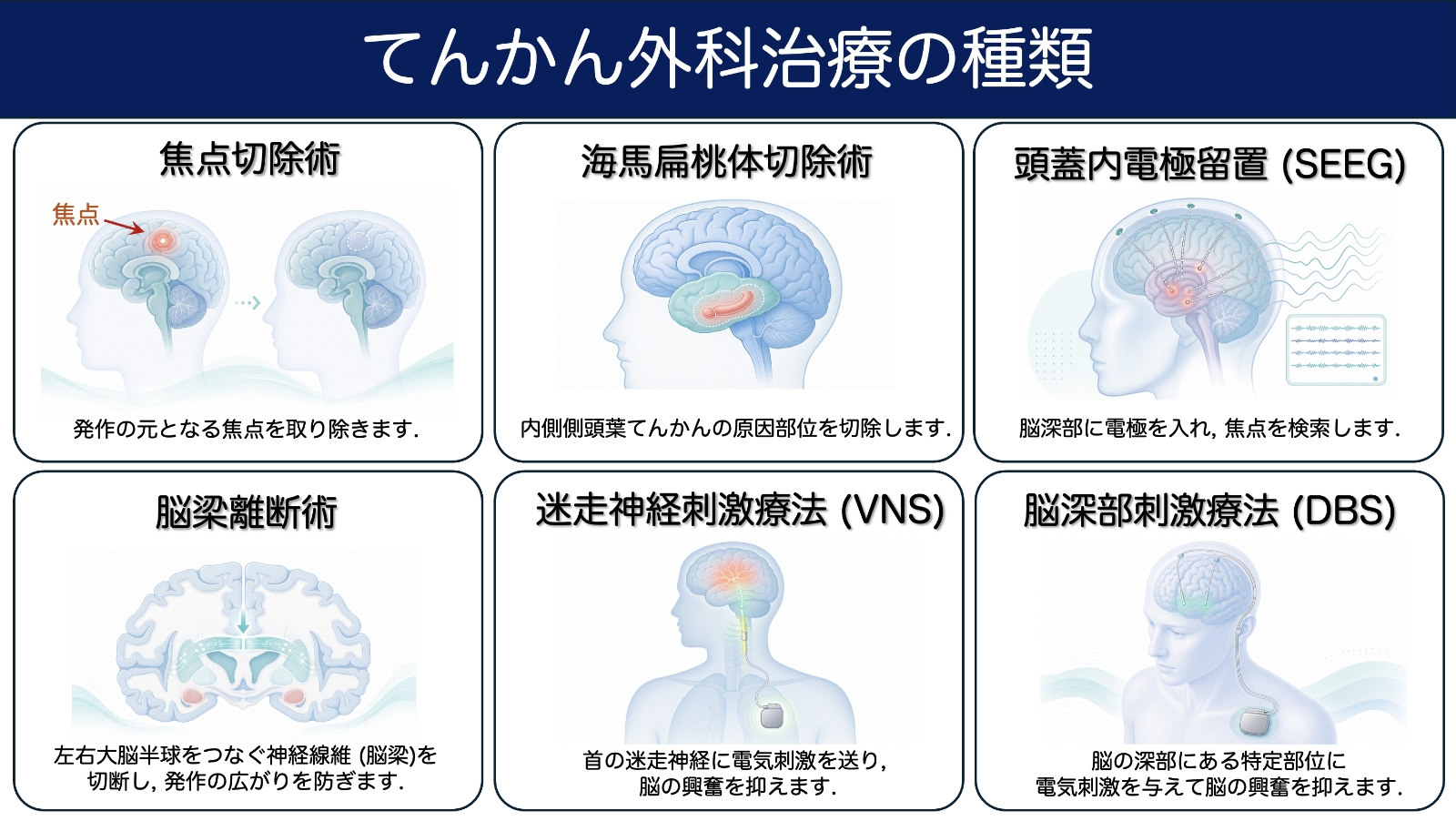 てんかん外科治療の種類