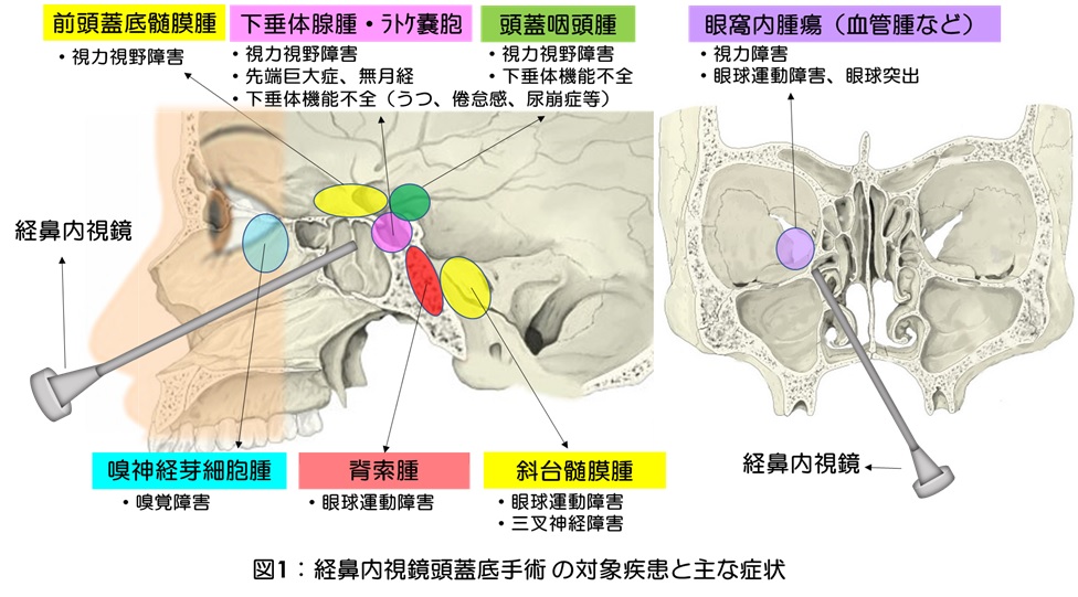 経鼻内視鏡頭蓋底手術| 慶應義塾大学病院脳神経外科教室