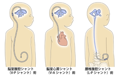 治療法（手術）