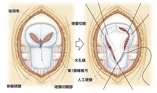 治療法（手術）